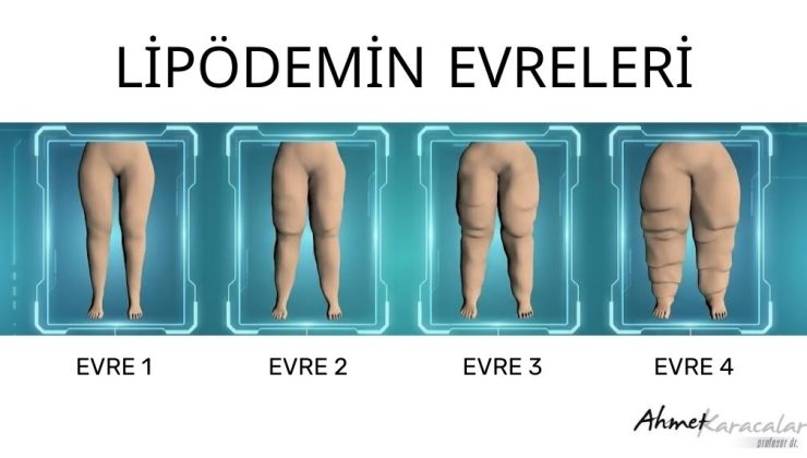 Diyet ve Spora Rağmen İnmeyen Yağlara Dikkat! Lipödem Hastalığı Olabilir