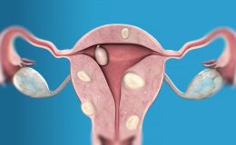 Myoma Uteri Tedavisi