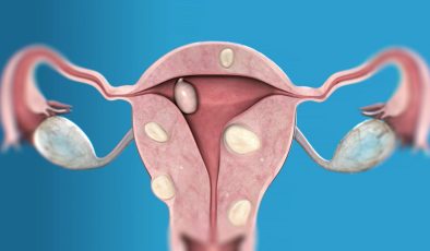 Myoma Uteri Tedavisi