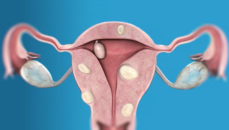 Myoma Uteri Tedavisi